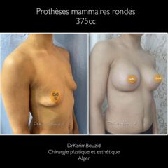 Augmentation mammaire - Dr Karim Bouzid