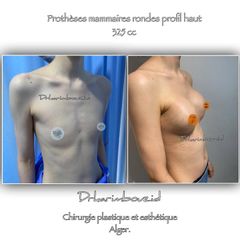 Augmentation mammaire - Dr Karim Bouzid