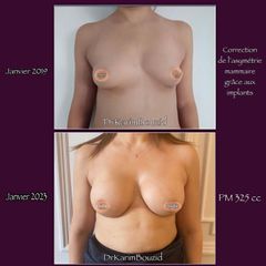 Augmentation mammaire - Dr Mathieu Piquet
