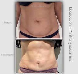 Liposuccion - Dr Karim Bouzid