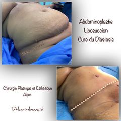 Abdominoplastie - Dr Karim Bouzid