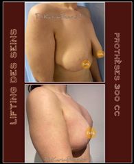 Augmentation mammaire - Dr Karim Bouzid