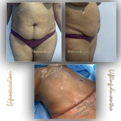 Abdominoplastie - Dr Karim Bouzid