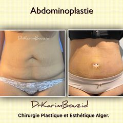 Abdominoplastie - Dr Karim Bouzid