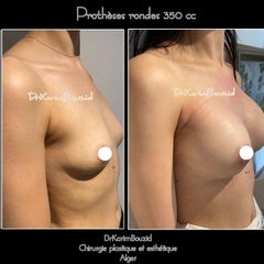 Augmentation mammaire - Dr Karim Bouzid