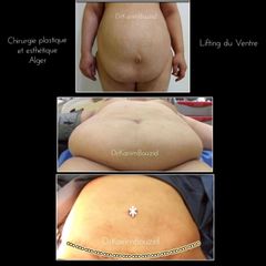Abdominoplastie - Dr Karim Bouzid