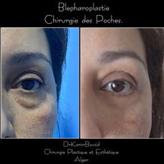 Blépharoplastie - Dr Karim Bouzid