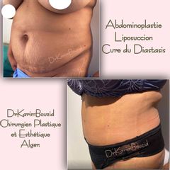 Abdominoplastie - Dr Karim Bouzid