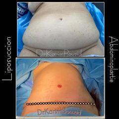 Abdominoplastie - Dr Karim Bouzid