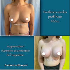 Augmentation mammaire - Dr Karim Bouzid