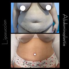 Abdominoplastie - Dr Karim Bouzid