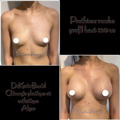 Augmentation mammaire - Dr Karim Bouzid