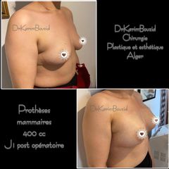 Augmentation mammaire - Dr Karim Bouzid