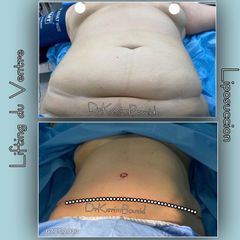 Abdominoplastie - Dr Karim Bouzid