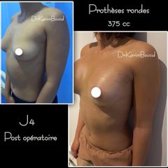 Augmentation mammaire - Dr Karim Bouzid