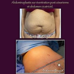 Abdominoplastie - Dr Karim Bouzid