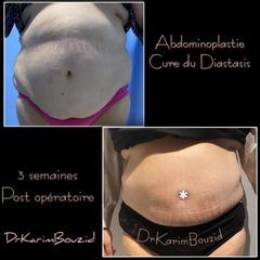 Abdominoplastie - Dr Karim Bouzid
