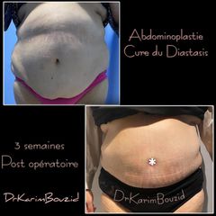 Abdominoplastie - Dr Karim Bouzid