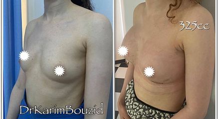 Augmentation mammaire - Dr Karim Bouzid