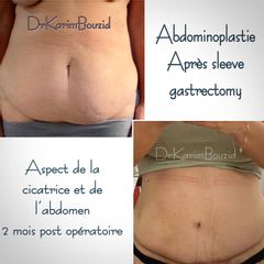 Abdominoplastie - Dr Karim Bouzid