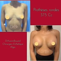 Augmentation mammaire - Dr Karim Bouzid