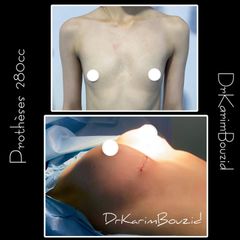 Augmentation mammaire - Dr Karim Bouzid