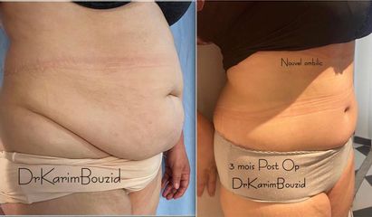 Abdominoplastie - Dr Karim Bouzid