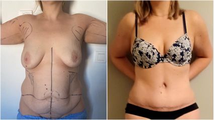Abdominoplastie - Dr Anas Gherissi