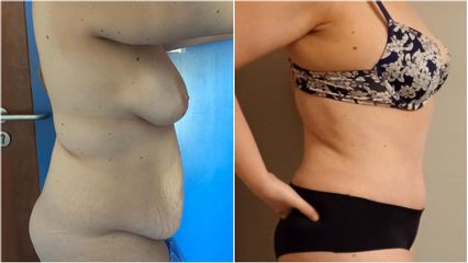 Abdominoplastie - Dr Anas Gherissi
