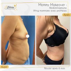 Augmentation mammaire - Dr Anas Gherissi - Dr Anas Gherissi