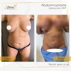 Abdominoplastie - Dr Anas Gherissi
