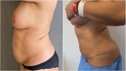 Abdominoplastie - Dr Anas Gherissi