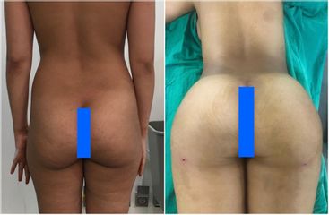 Chirurgie des fesses - Dr Noureddine Gharib