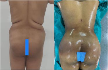 Liposuccion - Dr Noureddine Gharib