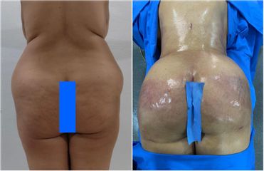 Liposuccion - Dr Noureddine Gharib
