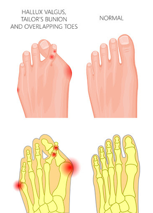 Malformation hallux valgus