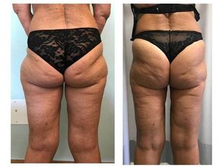 Liposuzione prima e dopo