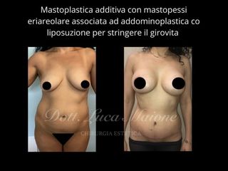 Mastoplastica additiva - Dott. Luca Maione