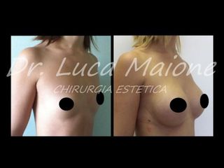 Mastoplastica additiva - Dott. Luca Maione