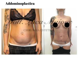 Addominoplastica - Dott. Luca Maione