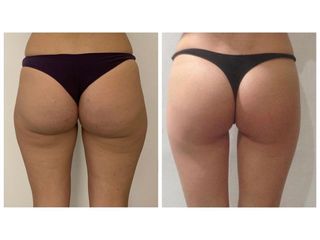 Gluteoplastica - Dottor Naser Jabbarpour esperto in medicina estetica e in tricologia