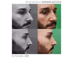 Rinoplastica - Dott. Francesco Lino