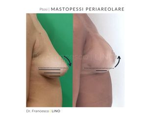 Mastopessi - Dott. Francesco Lino