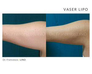 Liposuzione - Dott. Francesco Lino