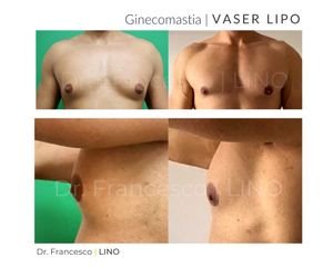 Ginecomastia - Dott. Francesco Lino
