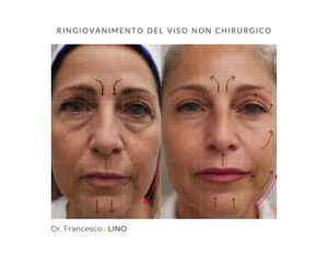 Ringiovanimento viso - Dott. Francesco Lino