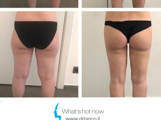 Liposcultura prima e dopo