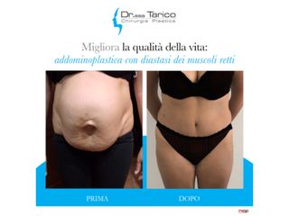 Addominoplastica prima e dopo