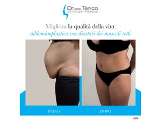 Addominoplastica prima e dopo