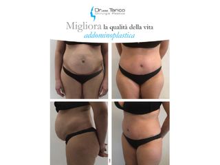 Addominoplastica prima e dopo